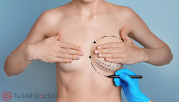 Breast Reduction (Reduction Mammoplasty)