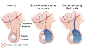 Hydrocele treatment of the spermatic cord