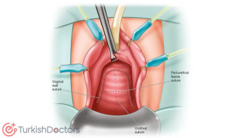 Surgery of the urethra
