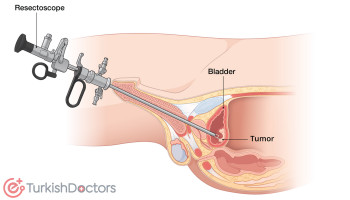 Transurethral resection of a bladder tumor