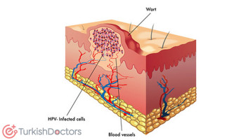 Treatment of genital warts