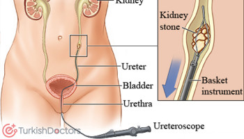 Ureteroscopy